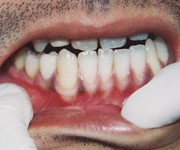 歯肉のホワイトニング術前