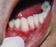 歯肉のホワイトニング術後
